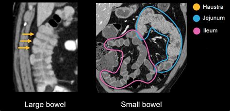 CT scan of the large intestine in medical centers in Richardson