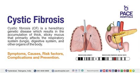 Cystic fibrosis - Wikipedia, the free encyclopedia - raincitystudios.com