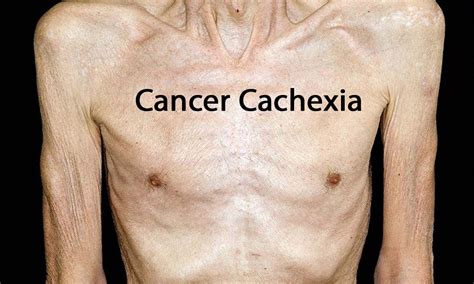 Cachexia & precachexia