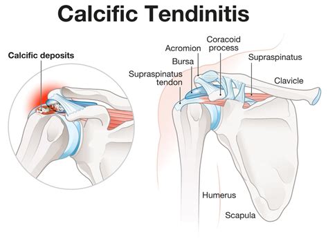 Calcific Tendonitis: Symptoms, Causes, & Treatment