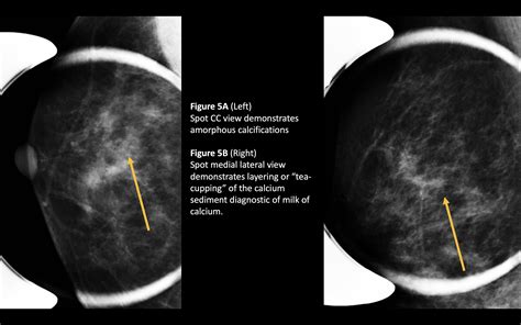 Calcium Deposits In Breast Ducts