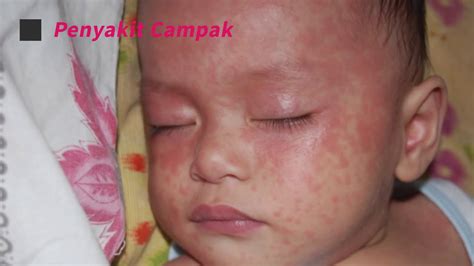 Calcula...</div. .  <a href=https://lookrussian.ru/d8rwbksu/waspada-campak-pada-anak...