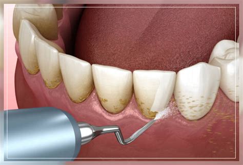  How is a calculus bridge removed? Being familiar with the procedure of removing blood and calculus, also known as debridement, is an essential element of becoming a dental hygienist. Handheld dental equipment such as periodontal scalers, curettes, hoes, files, and chisels are used by hygienists to remove calculus as effectively as possible. .