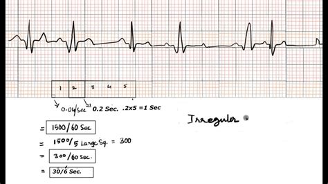 Calculation of hr in ecg
