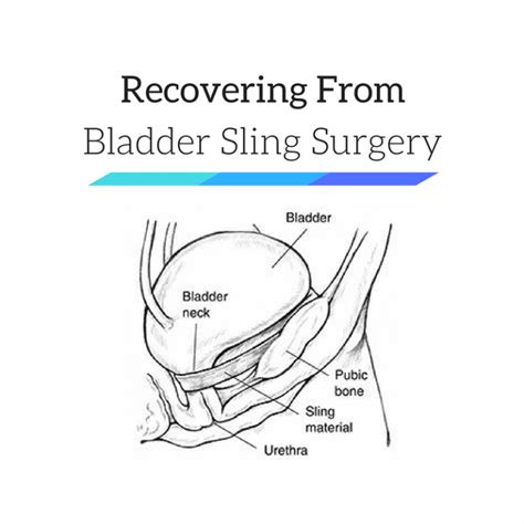 Can A Bladder Sling Be Removed - HealthyBladderClub.com