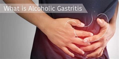 Can Alcohol Use Cause Gastritis? Effects Of Alcohol On The …