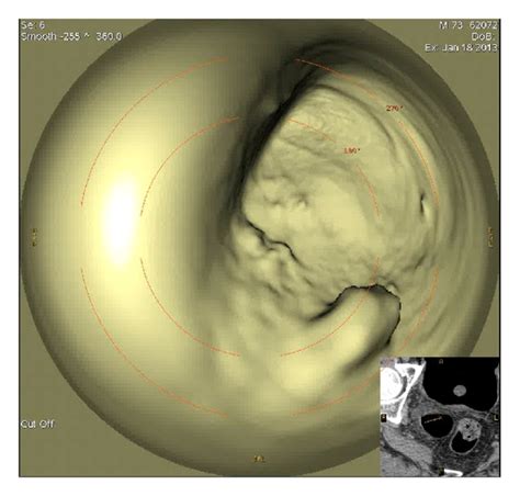 Can CT Virtual Cystoscopy Replace Conventional Cystoscopy in ... - Hindawi