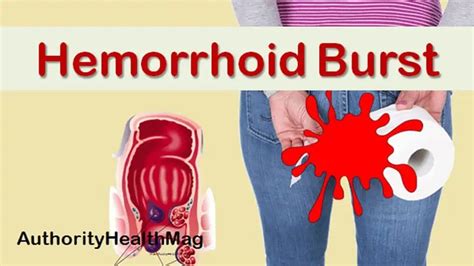 Can Hemorrhoids Burst, Rupture, Or Pop? - Authority …