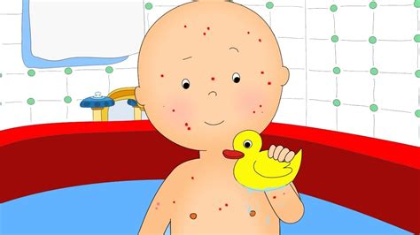 Can I Bathe with Soap During Chicken Pox? Controlling The Itch …