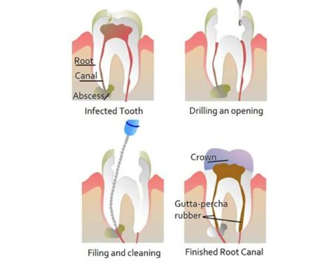 Can I Sue My Dentist for a Botched Root Canal? - Rosenbaum