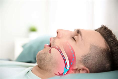 Can My Dentist Help Treat Sleep Apnea?