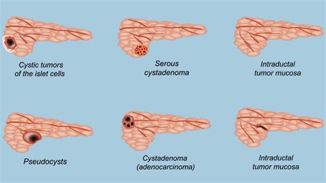 Can Pancreatic Cysts Cause Weight Loss & Can They Be …