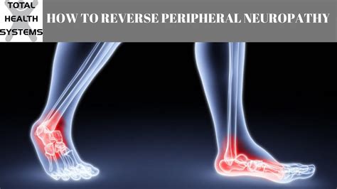 Can Peripheral Neuropathy Caused By Statins Be Reversed • …