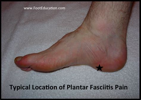 Can Plantar Fasciitis Cause Pain on the top of your Foot?