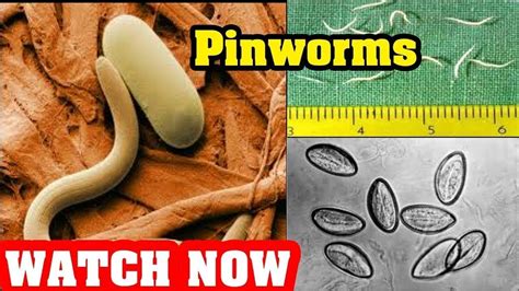 Can You Get Pinworms From Fish? - Stellina Marfa