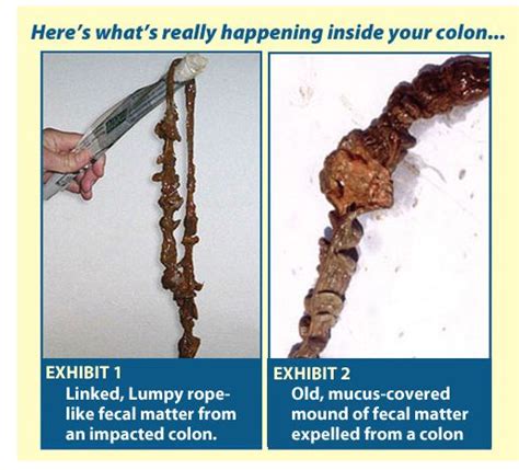 Can You Still Poop With Impacted Feces? - MedicineNet