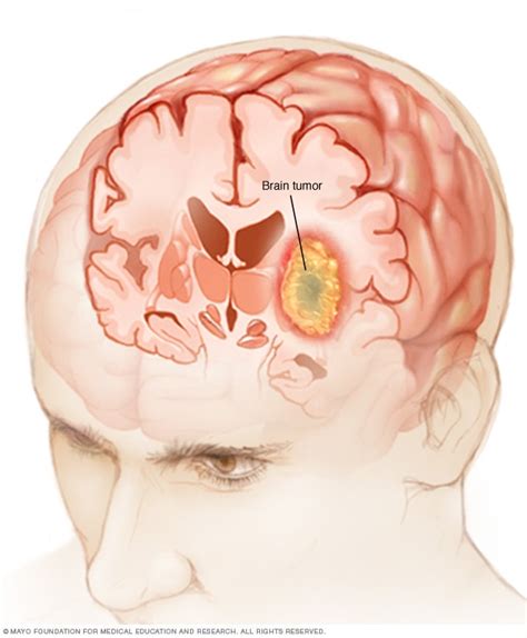 Can a Brain Tumor Cause a Headache in Same Spot …