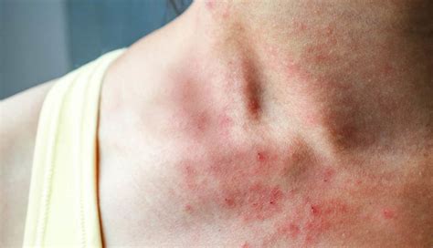 Can a Vitamin B Complex-12 Deficiency Cause Itchy Skin