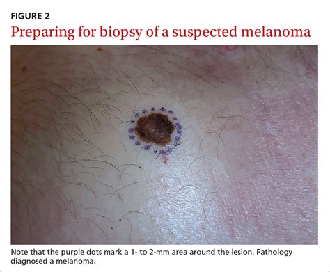 Can a botched biopsy spread skin cancer? - Healthy Debate