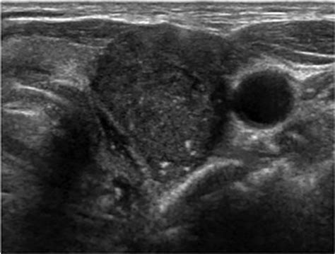 Can a solid hypoechoic thyroid nodule be benign.  This darker appearance is...