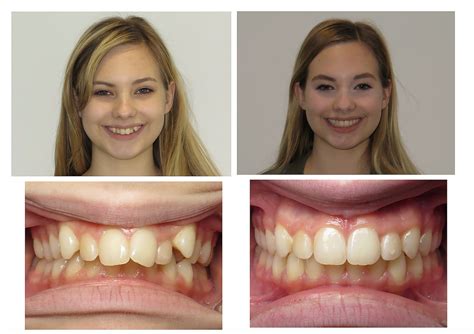 Can adult braces fix an overbite? - Quora