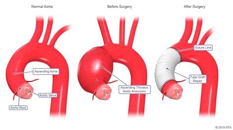 Can an ascending aortic aneurysm shrink by itself