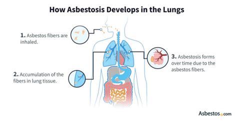 Can asbestos cause COPD Effects of exposure and more