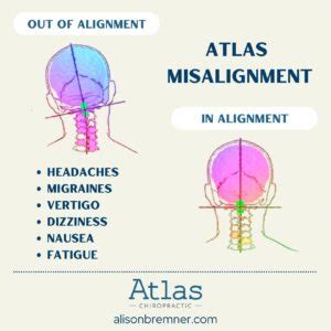 Can atlas misalignment cause vertigo.  Use it to create social media posts, prese...