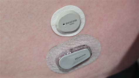 I wore my Dexcom on my left arm and the Omnipo