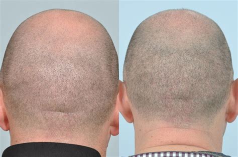 Can head be shaved after Fue hair transplant? - RealSelf.com