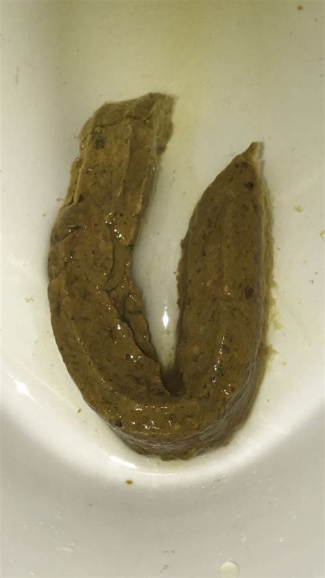 Narrowing of the stool may be due to a mass in the colon or rectum that limits the size of the stool that can pass through it. Conditions that cause diarrhea can also cause pencil thin stools. Persistent pencil thin stool, which may be solid or loose, is one of the symptoms of colorectal polyps or cancer.. 