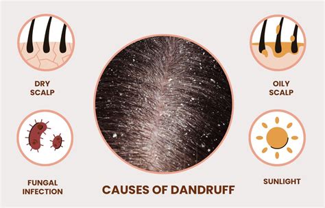 Can leave in conditioner cause dandruff - Life Top Style