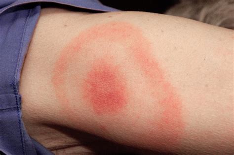 Symptoms of Rocky Mountain spotted fever start two days to two weeks after an infected tick bites you. Symptoms usually develop over a few days, starting with fever, headache, nausea, vomiting and muscle pains. Rash develops within three days in about 50% of people. Don’t wait for rash to appear to seek treatment.. 