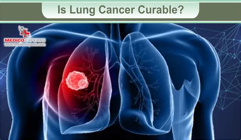 Can lung cancer be cured? HealthTap Online Doctor