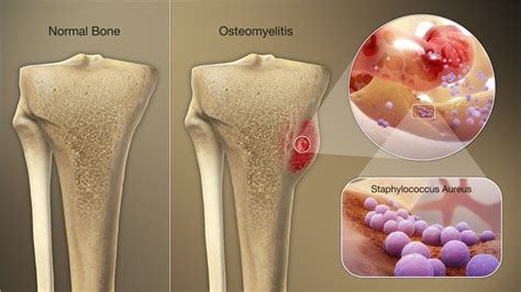 Can osteomyelitis return? - Answers