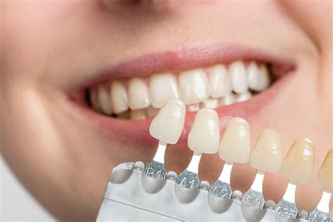 Can veneers be covered by insurance. Things To Know About Can veneers be covered by insurance. 