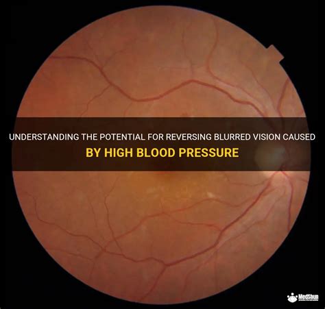 Can vision loss from high blood pressure be reversed?