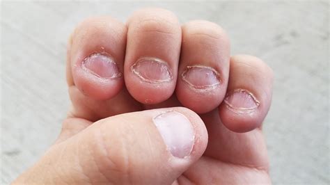 Can you get a tapeworm from biting your nails?