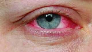 Can you get pink eye from a fart? - Family Health Desk