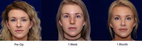 Can you mess up your rhinoplasty It may are some of the most asked questions about the use of Sure Jell, along with their answers: Q1: How long does it last? The Certo method is effective for at most 5 hours
