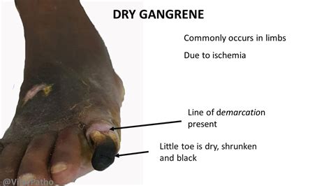 Can you please tell me how infarction and gangrene differ?