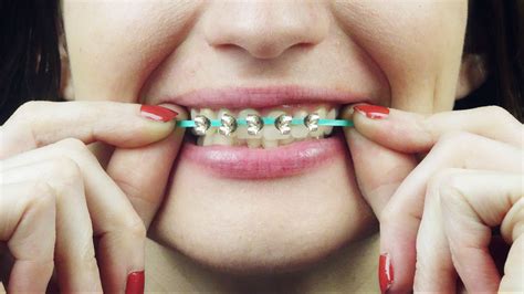 Can you put a fake tooth on braces? – Sage-Advices