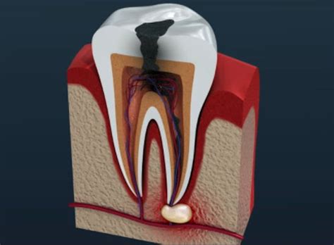 Can you talk after a root canal? - Quora