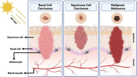 Cancer Cell Squamous Power up your knowledge on Squamous Cell