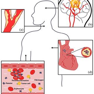 Cancer- and cancer-treatment-related mechanisms that may lead …