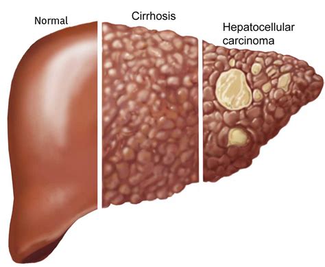 Cancerous tumours of the liver Canadian Cancer Society