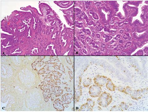 Cancers Free Full-Text Mixed Adenoneuroendocrine Carcinomas …