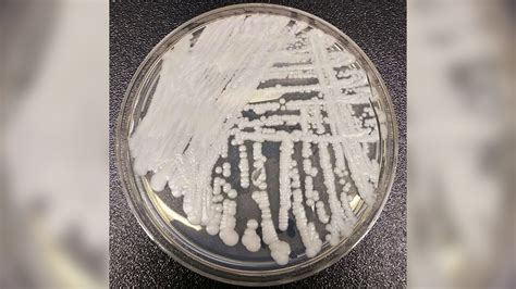 Candida auris: Everything you need to know about the deadly fungus spreading across the US
