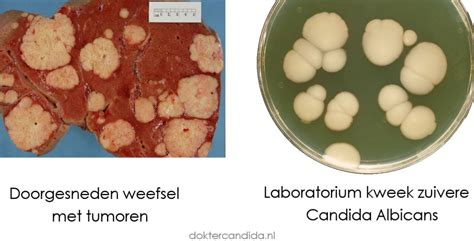 Candida is gevaarlijk! Wat is Candida? 👍