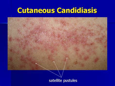 Candidiasis infection in skinfolds or in the navel usually causes a bright red rash, sometimes with breakdown of skin. Small pustules may appear, especially at the edges of the rash, and the rash may itch intensely or burn. A candidal rash around the anus may be raw, white or red, and itchy. Infants may develop a candidal diaper rash .. 